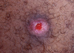 Figure 8. Sebaceous gland carcinoma (SGC).