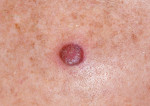 Figure 11. Atypical fibroxanthoma (AFX).