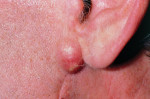 Figure 13. Sebaceous cyst.