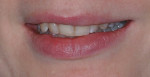 Figure 2. The patient’s concerns with her smile included tooth color, the uneven length of the maxillary central incisors, and the prominence of the upper left canine.
