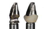 Figure 8. A metal abutment was chosen because of its physical properties, and a ceramic margin was used to aid the transmission of light into the tissue around tooth No. 11.