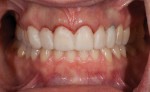 Figure 7. The provisional restorations in place showing the gingival symmetry after crown lengthening on teeth Nos. 7 through 9. Note the darkness in the gingival area of tooth No. 11.