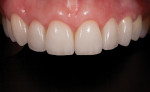 Figure 12. The final restorations showing the healing of the tissue around the crown-lengthened teeth Nos. 7 through 9.