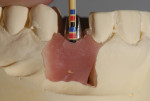 Figure 9. The margin placement of the custom abutment was located 0.5-mm apical to the free gingival margin, allowing proper emergence and ease of cement cleanup.