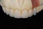 Figure 11. The final restorations on the cast. A slight color discrepancy of the ceramic veneer restorations was noted when compared to the implant restoration based on the underlying color of the stone model.