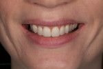 Figure 17. The completed restorations and gingival display during a normal smile.