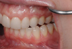 Figure 15. The tissue around the implant-supported crown No. 11 was pink and healthy and exhibited good light transmission at the gingival margin.