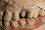 Figure 3 The pressed abutment was characterized using IPS e.max stains.