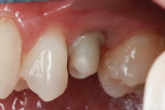Figure 7 Lateral view of the IPS e.max Press abutment after seating and torqueing. Note the equigingival margins.