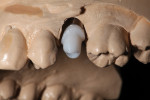 Figure 2 View of the IPS e.max Pressed hybrid abutment on the model. The pressed hybrid abutment crown was cut back for layering.
