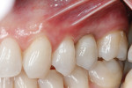 Figure 9 Immediate postoperative lateral view of the final IPS e.max Press hybrid abutment and pressed crown restoration.