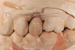Figure 4 A full-contour wax-up of the IPS e.max Press crown restoration was created on the stained abutment.