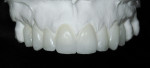 Figure 6 Diagnostic esthetic wax-up created from initial maxillary cast.