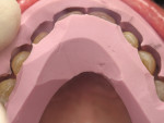 Figure 11 The incisal preparation guide was used to verify proper reduction.