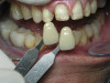 (1.) Maxillary wax rim in a patient’s mouth with midline and high smile line marked.