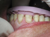 (2.) Maxillary wax rim in a patient’s mouth with denture teeth Nos. 8 and 9 set into place.