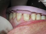 Figure 10 The buccal preparation guide was used to verify proper reduction.