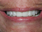 Figure 17 Postoperative smile view.