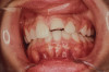 (12.) Retracted view of final complete dentures fabricated using this approach.