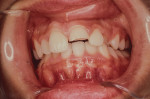 Figure 3 Injury sustained while wearing a boil and bite mouthguard.
