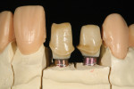 Figure 8 Higher translucency levels in zirconia reduce the need for layering. In this case, a full-contour design leaves the incisal edge in zirconia to prevent chipping.