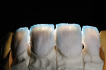 Figure 5 The powder buildup used in fabricating feldspathic veneers allows variable translucency and opacity within the restorations.