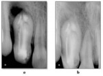 Figure 2. a) Immediate postoperative radiograph; b) 6 months follow-up radiograph.