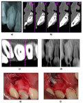 Figure 1. a) Preoperative radiograph; b) CT scan revealing anatomy of tooth in labio-lingual section; c) CT scan showing cross-section of tooth at middle 1/3rd of the root; d) working length radiographs; e) intraoperative photograph showing large periapical pathology; f) retrograde placement of MTA.