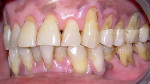 Figure 4  Advanced combined bioocorrosion/abfractions in tooth Nos. 6, 8, 9, and 11 through 14 caused by both static stress and fatigue (cyclic) stress, and the consumption of a highly acidic beverage called Bissap (sorrel) in a 69-year-old male with