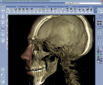 Figure 2  With CBVT technology, volume ranges can be produced to view a single tooth or whole skull region. Lasers scan the face while a digital camera captures the facial images. Soft-tissue images can be overlaid on top of the cone beam images, ena