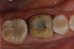 Crown preparation of tooth No. 30.