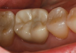 Restoration placed in the patient’s mouth.