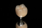 Completed GC GRADIA SR Implant with wear faucets exposing internal structures and translucency.