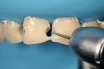 Figure 4  Preparation involved removing the defective composite restorations, placing a 1-mm bevel along the cavosurface margins, and minor beveling along the wear line of the incisal edges.