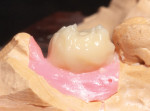 The opacious dentin build-up should comprise a larger volume than fired porcelain as it helps to create a more dense gingival and body shade.