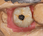Use mamelon stains or intensive colors to characterize the occlusion, mamelons, translucency, or internal crack lines.