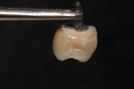 Fill IP voids with cervical translucency. (Note: Larger voids will require a layer of opacious dentin).