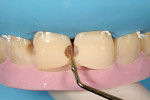 Figure 6  To establish a thin lingual shelf, the silicone matrix was positioned and firmly held against the teeth, while the composite was carefully sculpted to conform to the matrix boundaries.