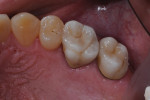 Occlusal view of seated PFM crowns.