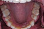 Maxillary arch showing both the new lithium disilicate crown and the contra-lateral old PFM.