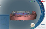 NobelProcera™ design screenshot of a mandibular full-wrap, screw-retained hybrid.