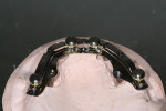 NobelProcera™ maxillary attached overdenture “Paris” bar with two Zygomatic implants.