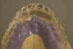 An existing prosthesis duplication in processed clear acrylic for implant placement diagnostics.