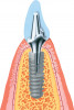 (7.) Fracture of the crestal portion of an implant caused by mechanical overload.