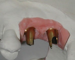 The abutments were seated on the cast and reviewed for proper support of the intended crowns.