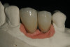 Fig 1 Clear orthodontic aligners manufactured in dental laboratories (images courtesy of Orthodent Laboratory).