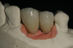 Veneering ceramics were then applied and fired, matching the prescribed shade and natural morphology of the teeth restored.
