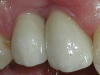 Fig 2. Clear orthodontic aligners manufactured in dental laboratories (images courtesy of Orthodent Laboratory).