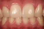Figure 10  At the 3-month follow-up, the single-shaded restorations present optimal esthetics.