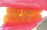 Lingoform® teeth in lingualized occlusion.
